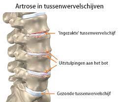 artrose rugpijn