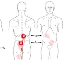 dry needling lage rugpijn