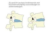 lage rugpijn artrose