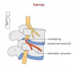 hernia lage rug behandeling