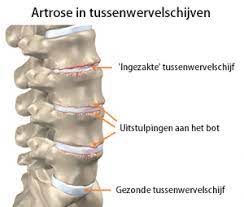 rugpijn rechts midden