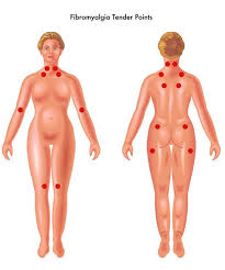 fibromyalgie rugpijn
