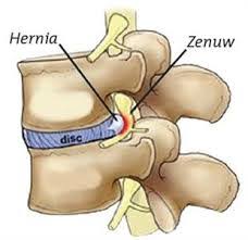 rugpijn hernia en spit