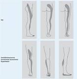 pijn in been door rug