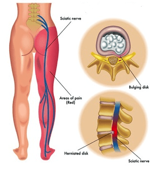 last van onderrug en benen