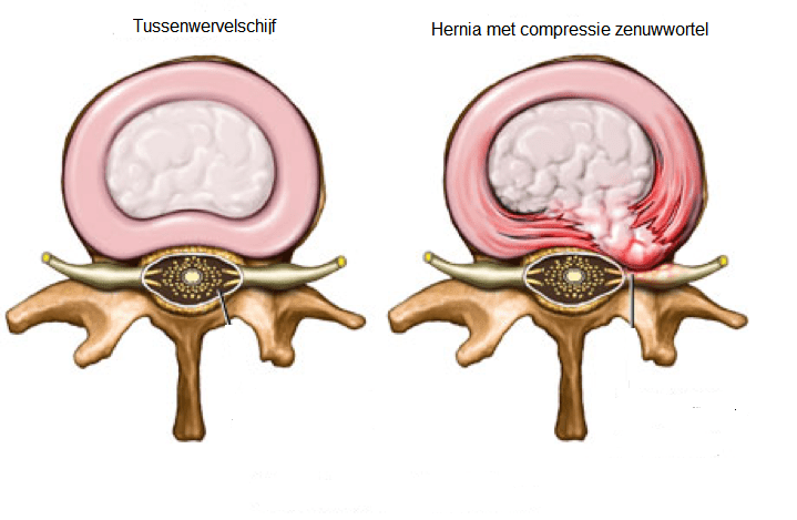 nekhernia duizeligheid