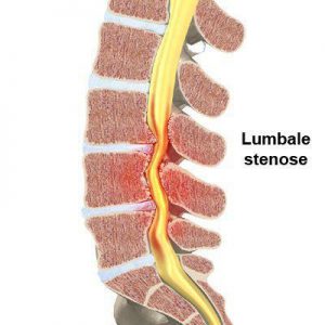 overgang en rugklachten