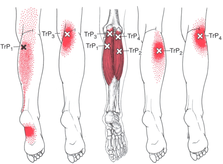 rugklachten uitstraling been