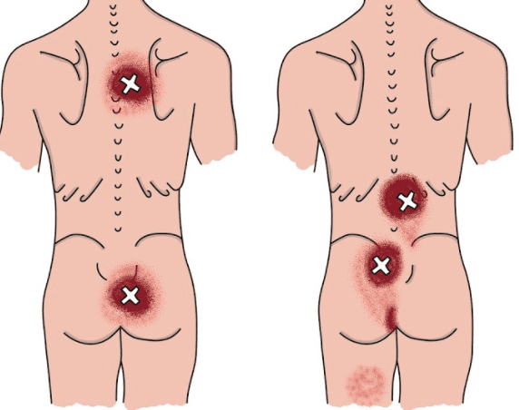 aspecifieke lage rugklachten