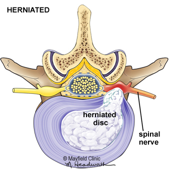 behandeling rughernia