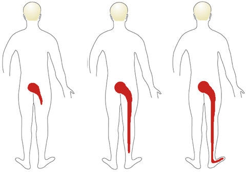 extreme pijn onderrug