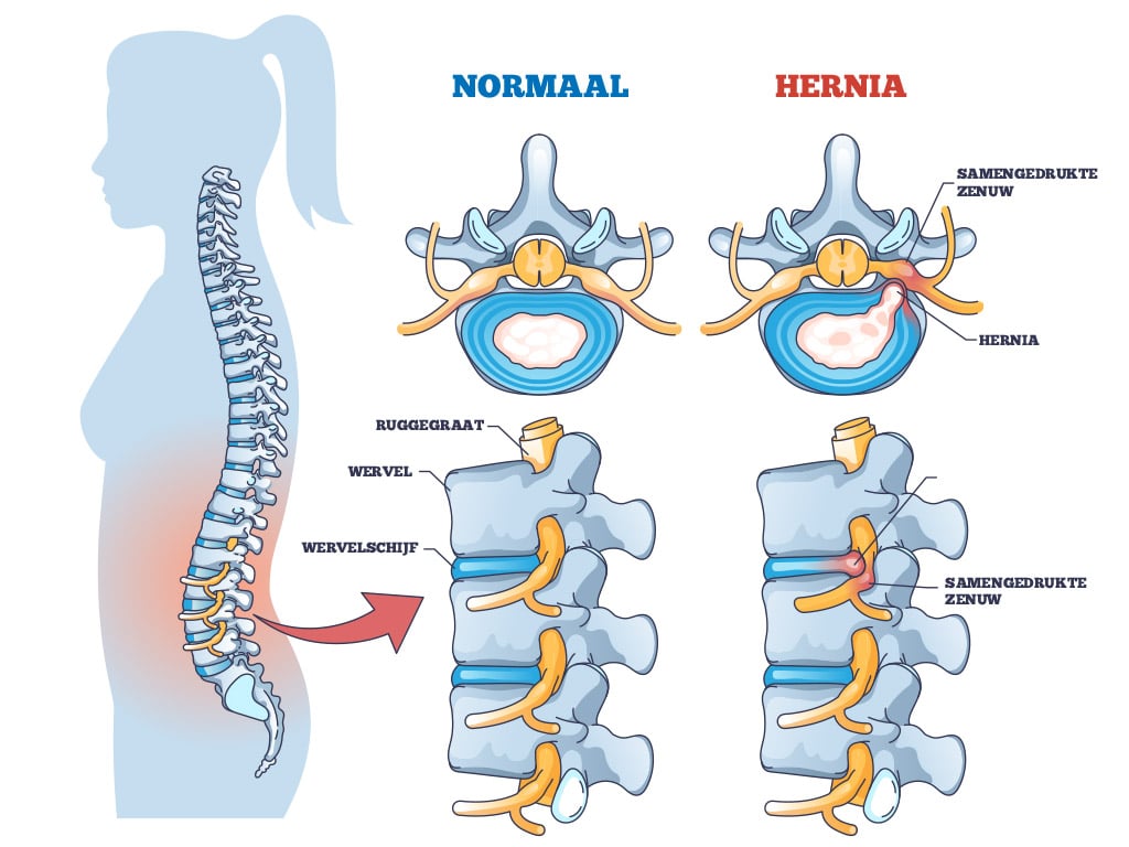 therapie bij hernia