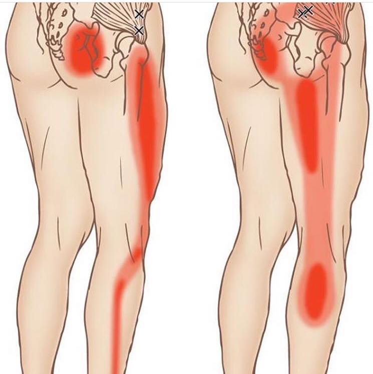 pijn in onderrug bij opstaan