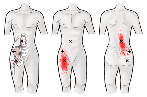 pijn in onderrug links en been