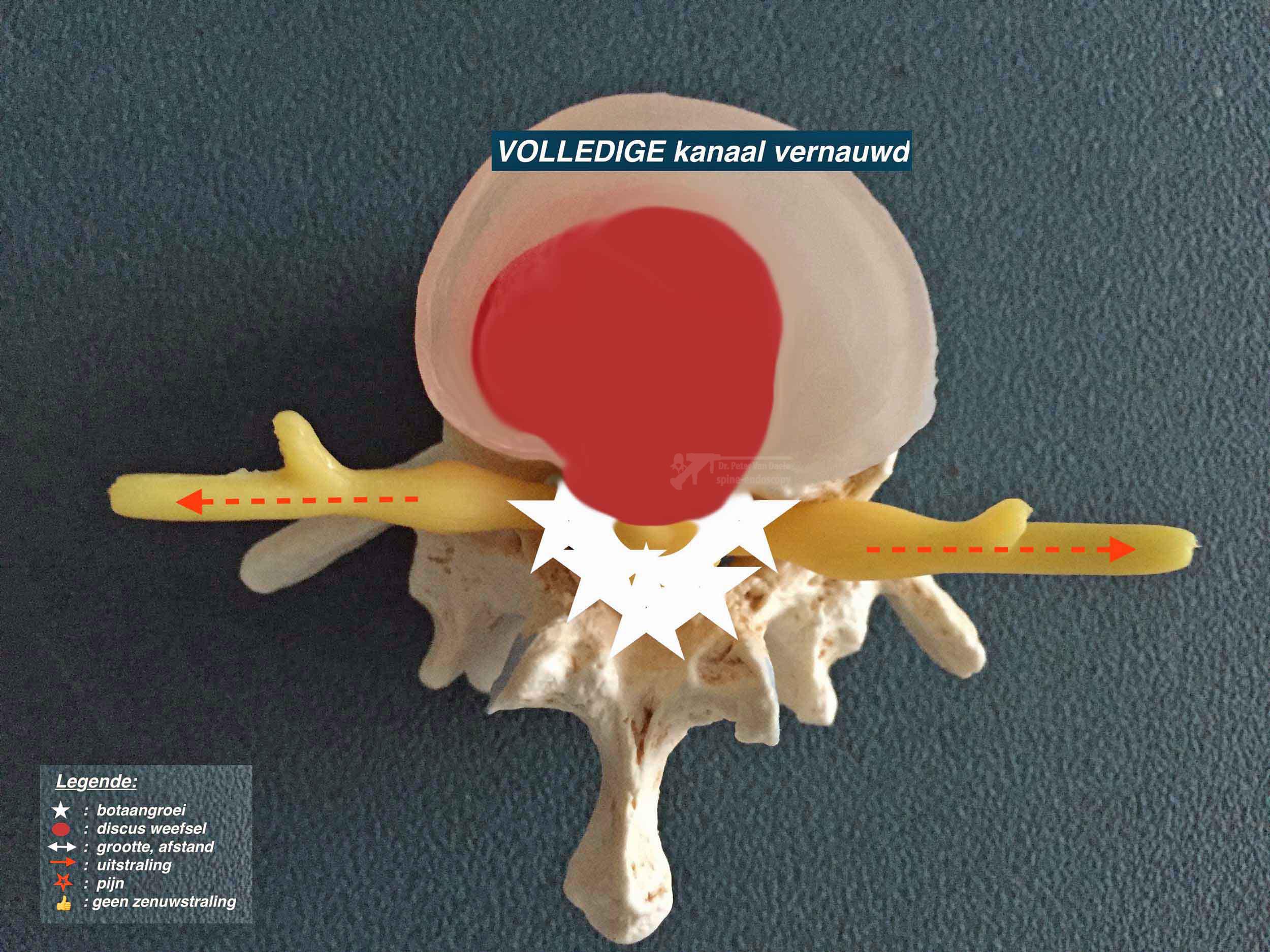 pijn onderrug links uitstraling been