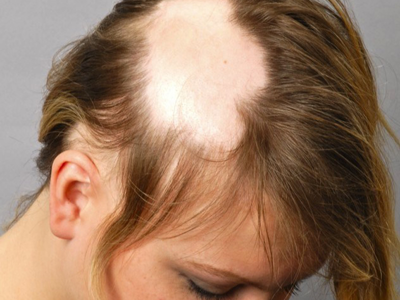 alopecia behandeling