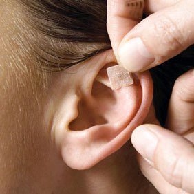 acupunctuur afvallen