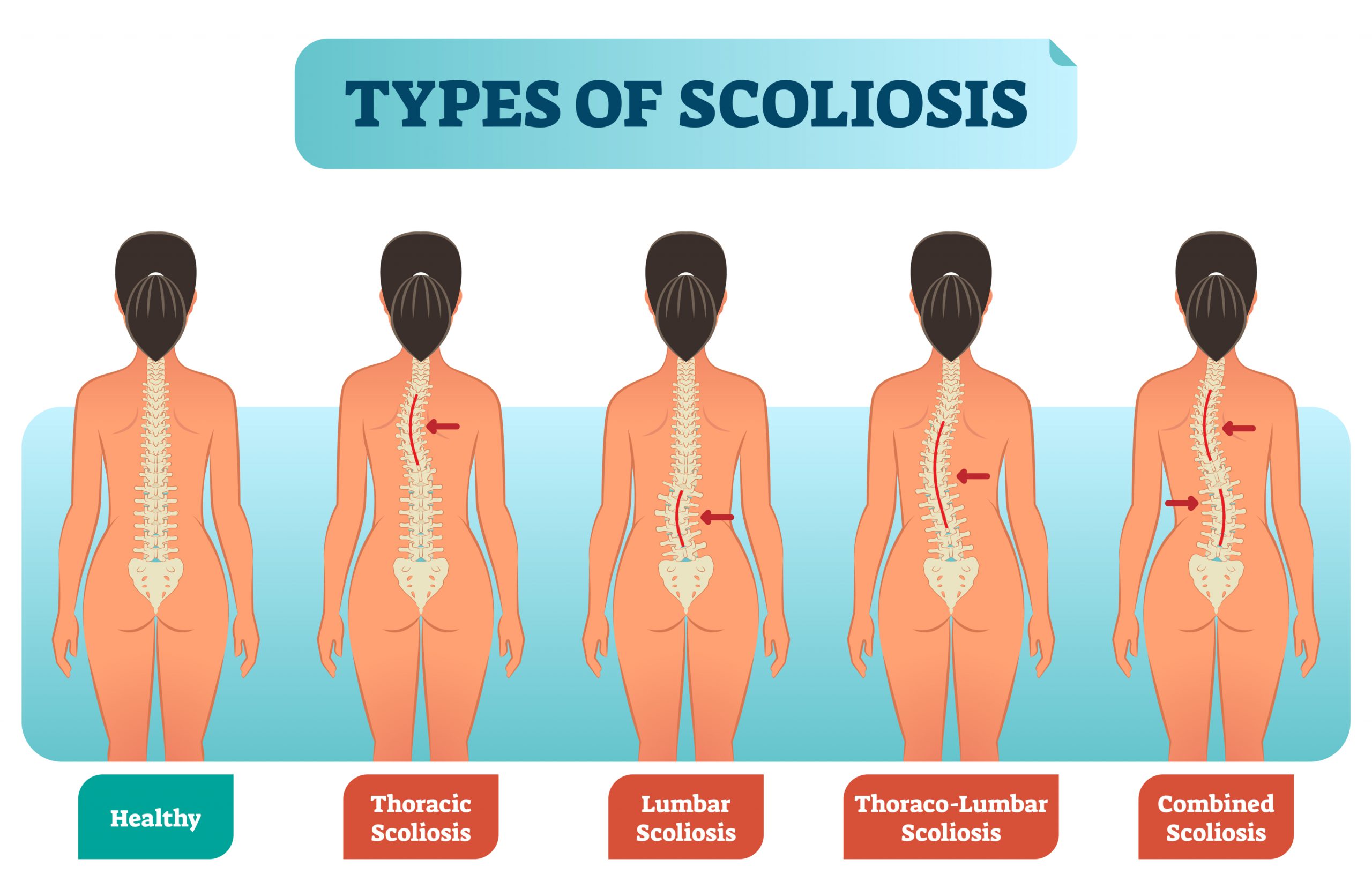 scoliose oorzaak